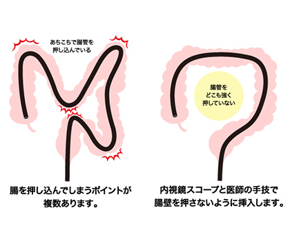 腸の不快感を減らす「軸保持短縮法」