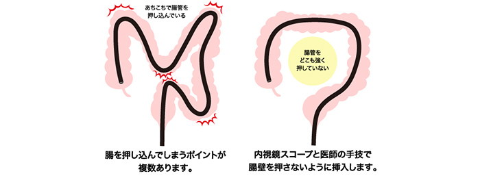 腸の不快感を減らす「軸保持短縮法」